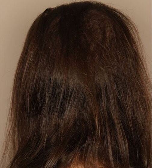 Ho smesso di perdere i capelli con Verdexil
