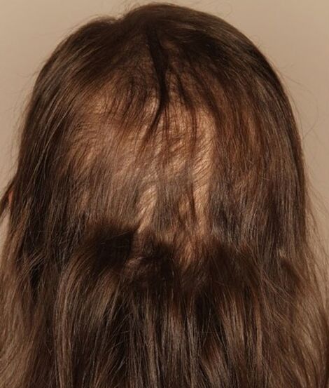 Perdita di capelli prima di usare lo spray verdexil